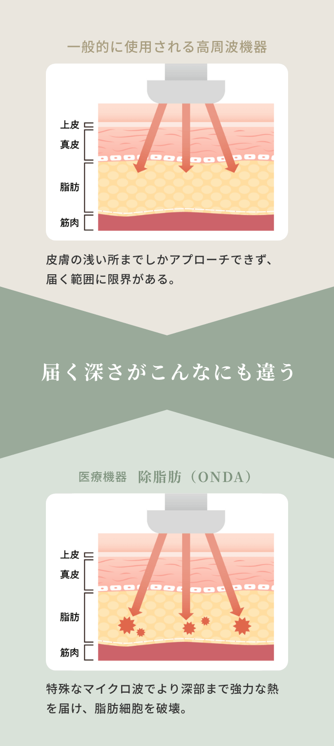 一般的に使用される高周波機器と除脂肪(ONDA)の違い。除脂肪(ONDA)は特殊なマイクロ波でより深部まで強力な熱を届け、脂肪細胞を破壊。届く深さの違いを表しているイラスト