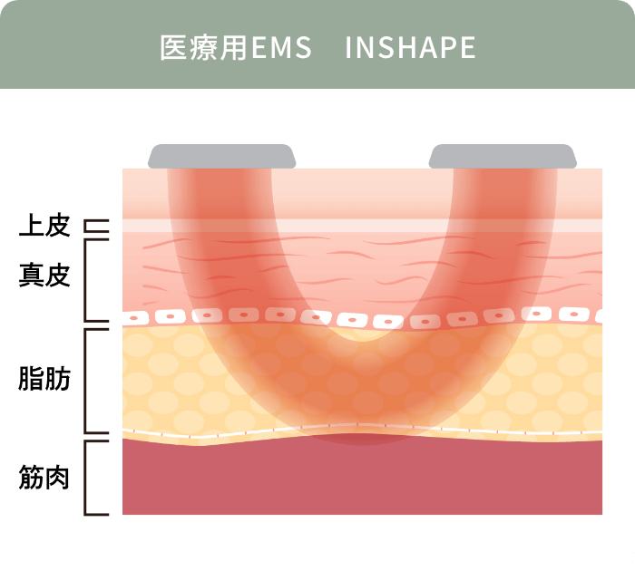 医療用EMS INSHAPE